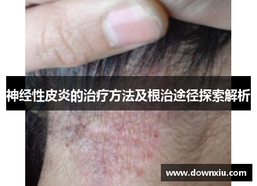 神经性皮炎的治疗方法及根治途径探索解析